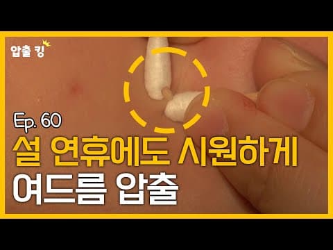 [압출킹] 60. 학생분들의 고민, 좁쌀 여드름 압출 ASMR ⭐도파민 주의!⭐