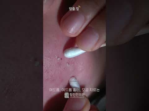 속피지까지 뽑는 여드름 압출 #ASMR #여드름압출 #여드름전문한의원