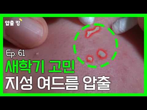 [압출킹] 61. 새학기 지성피부 여드름 압출 ASMR (+보너스 압출 클립)