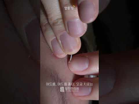 이마 부위 여드름 압출 #ASMR #여드름압출 #여드름전문한의원