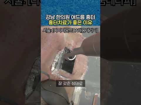 여드름흉터치료 전문 한의원의 치료 장점은?