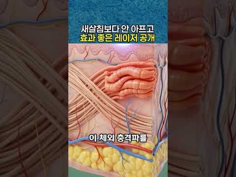 새살침, 서브시전보다 안 아프고 효과는 더 좋은 [다이아몬드DA채움테라피] 여드름 흉터치료 레이저