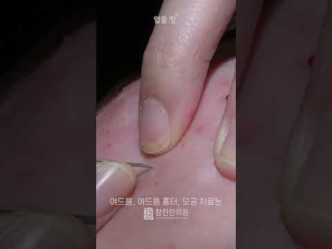 시원하게 바로 뽑히는 좁쌀 여드름 압출!  #ASMR #여드름압출 #여드름전문한의원