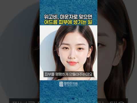 위고비, 마운자로 맞으면 여드름 심해진다? 그 진실을 공개합니다