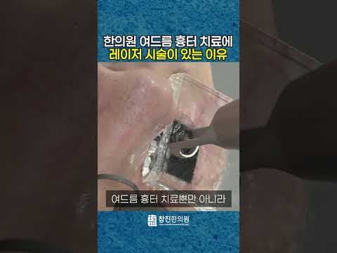여드름 흉터 치료 한의원이 피부과처럼 레이저 시술하는 이유